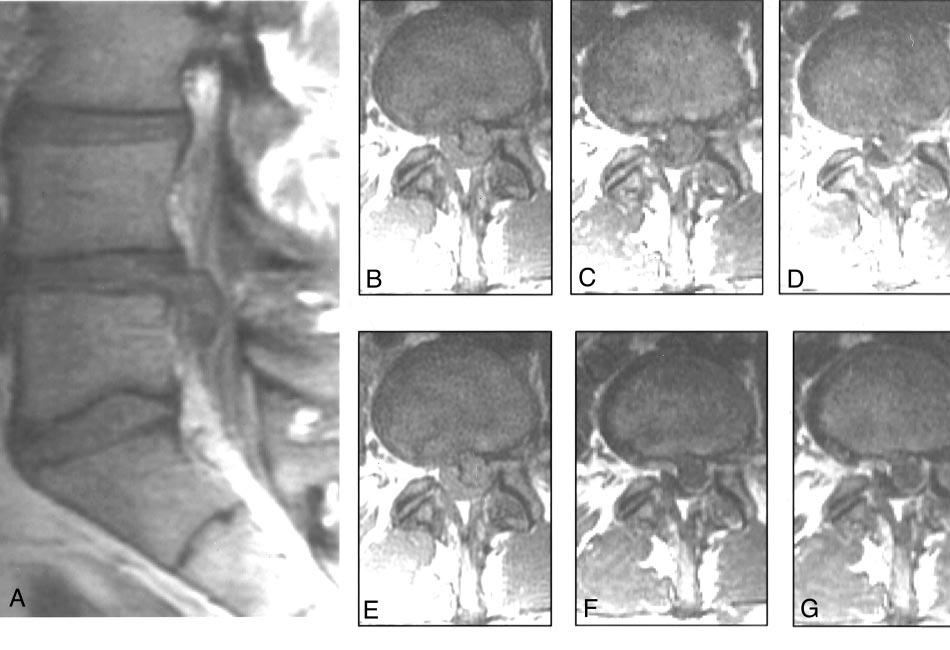 AJNR: 23, November/December 2002 RECURRENT HERNIATED DISK 1655 FIG 2. Sagittal unenhanced T1-weighted image (A) and axial images (B G) obtained in one patient.