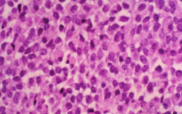 Progress in Pathology 6 Fig. 1.6 Monophasic synovial sarcoma composed of small cells. small cell population.