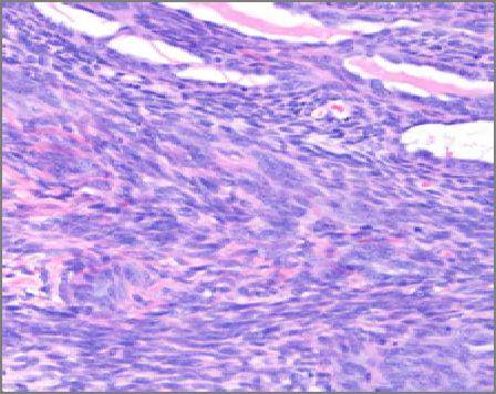 tumors Clear cell sarcoma Angiomatoid fibrous histiocytoma Extraskeletal myxoid