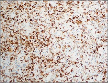 Highly expressed in Low-grade fibromyxoid sarcoma Hyalanizing spindle cell tumor with giant rosettes Sclerosing
