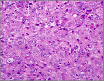 tumor INI 1 Rb Retinoblastoma gene 13q14 Tumor
