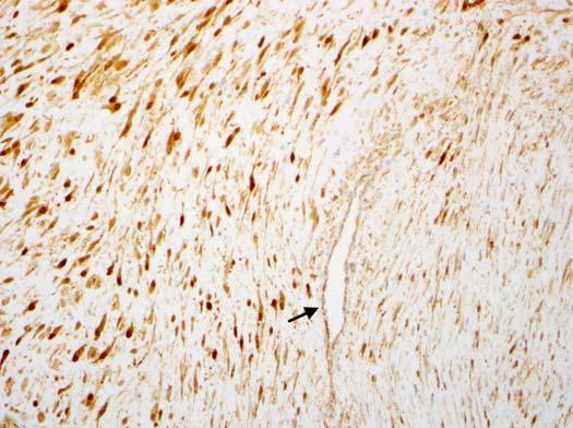 rhabdomyosarcoma Myxoid versus well-differentiated liposarcoma Predictive: Therapeutic