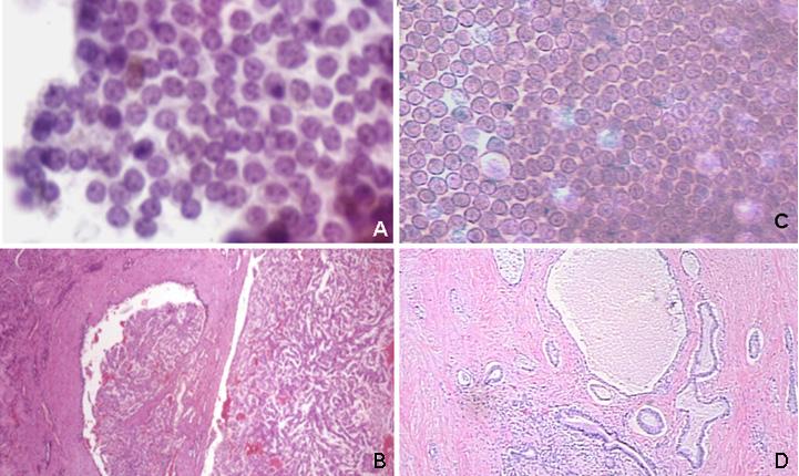 Approaches to the Interpretation of Transabdominal Fine-Needle Aspiration Biopsy 47 Fig. 3.1 Malignant cells that have a benign nuclear features.