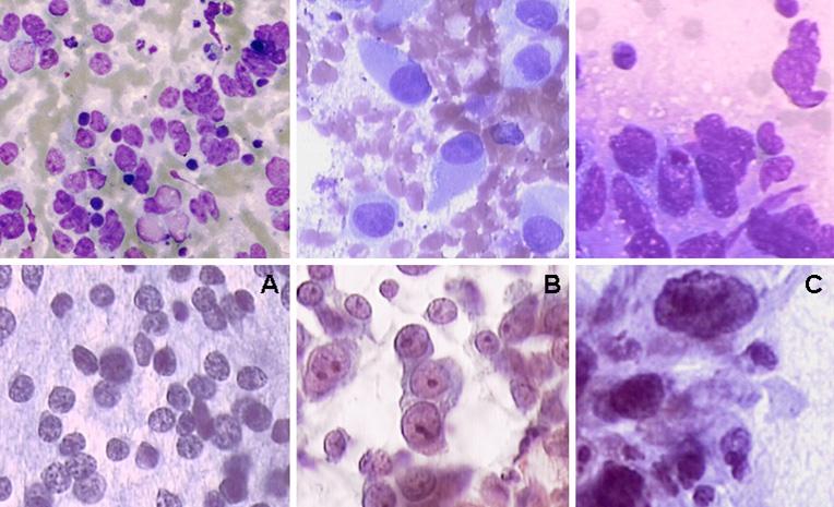 48 Transabdominal Fine-Needle Aspiration Biopsy Fig. 3.3 Average nuclear size in tumor cells.