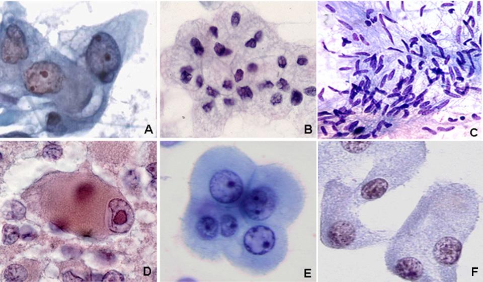 50 Transabdominal Fine-Needle Aspiration Biopsy Fig. 3.7 Cytoplasmic texture of tumor cells. UPF, 400.(A&B) Multivacuolated in adenocarcinoma.