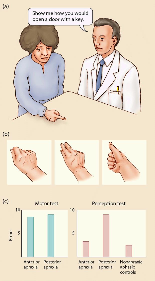 Thus, a lesion in the posterior parietal area will lead to apraxic movements with both contra-and ipsilesional limbs (Gazzaniga et al., 2002). (a): Motor; (b) perception test.
