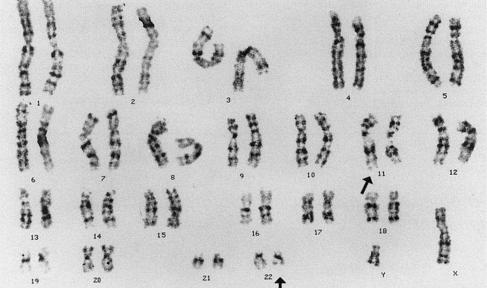 Conventional karyotyping EWSR1