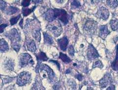 liposarcoma RT-PCR Small blue round cell