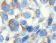 leukemia Small cell osteosarcoma