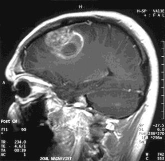 Brain Tumours http://www.braincancer.leeds.ac.uk/ www.topnews.
