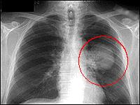 Lung cancer http://www.scientificpsychic.com/health/cancer.html http://www.kyma.
