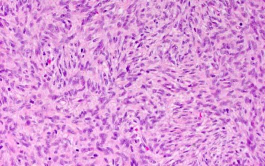 The following is true about this neoplasm with the EXCEPTION: A. This tumor shares similar cytogenetic abnormality with giant cell fibroblastoma B.