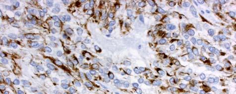 Tumor cells were positive for cytokeratin AE1/AE3, desmin (see image) and NSE.