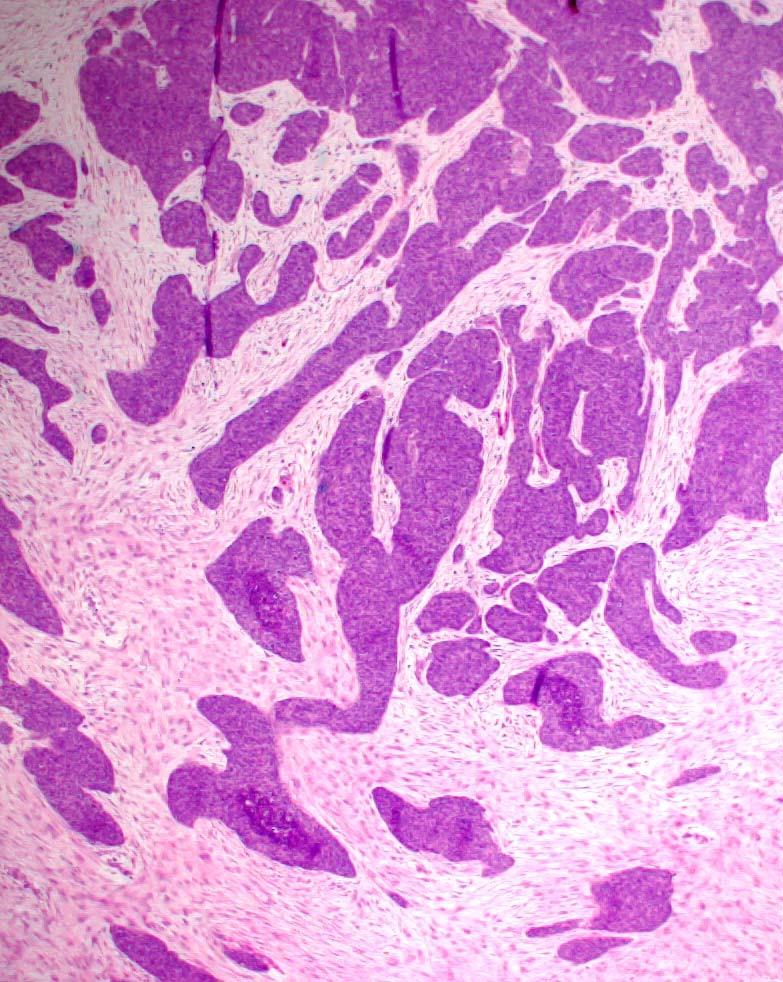 Desmoplastic Small Round Cell Tumor Abdominal/pelvic peritoneum Young males Aggressive clinical course Typical histology Immunohistochemistry