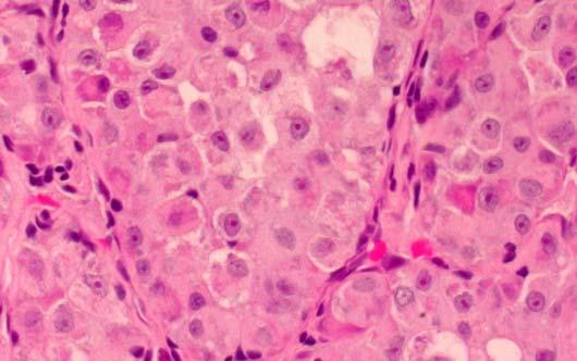 Renal cell carcinoma B. Alveolar soft part sarcoma C.