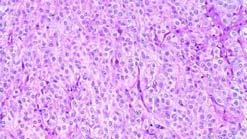 macronucleoli, osteoclast-like giant cells IHC Expression S100 protein and