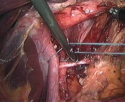 Figure 2. Preparation of the hiatus. Figure 4. Mobilization of the posterior vagal nerve. Figure 3. Identification of the hiatal crura. Figure 5. First suture.
