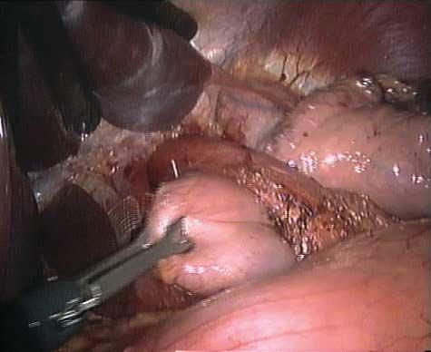 In 19 group 2 patients (42%) with a hiatal hernia larger than 5 cm, 3 to 4 sutures were used in addition to the mesh.