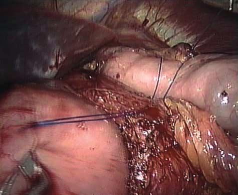 In the 18 patients (4%) in group 1 with a hiatal hernia larger than 5 cm, 3 to 4 sutures were placed for crural closure.