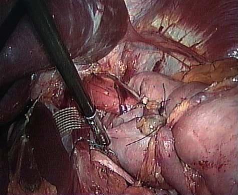 Shoeshine maneuver (pulling-through of the gastric fundus behind the esophagus). smaller or larger than 5 cm by using an endoscopic ruler.