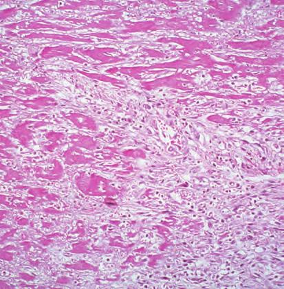 46 Chapter 3: Inflammation and Tissue Repair Necrotic (dead) myocardial muscle cells Mixture of fibrocytes and leukocytes Scar of dense fibrous tissue A Fibrosis New capillaries (angioneogenesis) B