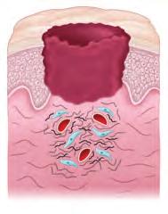Ulcers are a common complication of gastritis, one of the clinical models in this chapter.