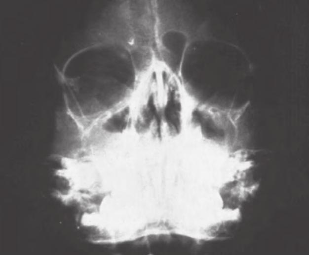 Applied Pathophysiology Clinical Models 51 Figure 3.14. Maxillary sinusitis. This radiograph demonstrates bilateral maxillary sinusitis.