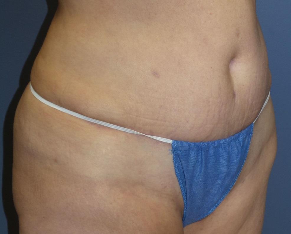 before her Tummy Tuck and 10 months