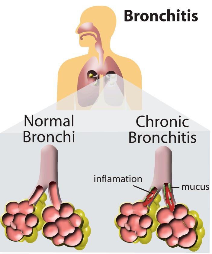 voices manageable Bronchitis Bronchi and bronchial tubes become irritated &