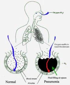 Pneumonia Emphysema Lungs lose elasticity (can t stretch). Alveoli wall is damaged and breaksdown.