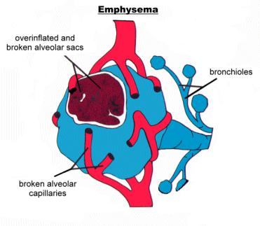 Irreversible (can t reverse) Symptoms: mild cough, weight loss, tired Fluid filled air spaces Cause: