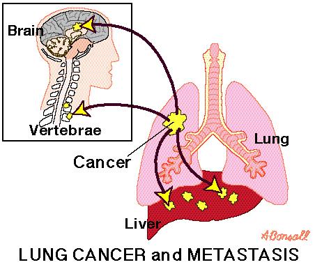 sacs Emphysema Lung Cancer Uncontrolled growth of abnormal lung cells (no function), can spread.