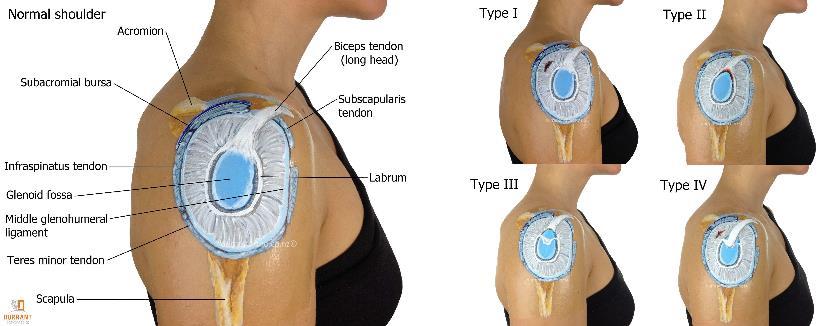 LABRAL INJURIES: SLAP TEARS Common in overhead use sports Baseball, Volleyball, Tennis