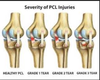 PCL INJURIES 5-20% of knee injuries Result of direct blow to anterior tibia Hyperflexion with