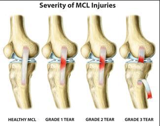 MCL SPRAIN Classification I-III Treatment Nonoperative vs operative