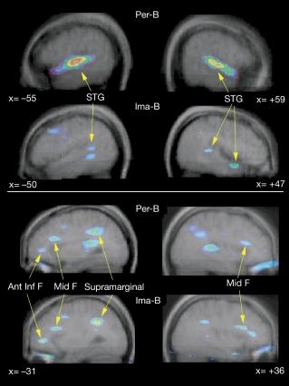 The top panel shows activation in the superior temporal gyrus (STG).