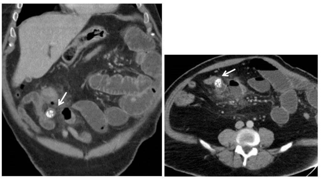 4: Coronal CT reconstruction and axial CT show a enterolith (arrow)