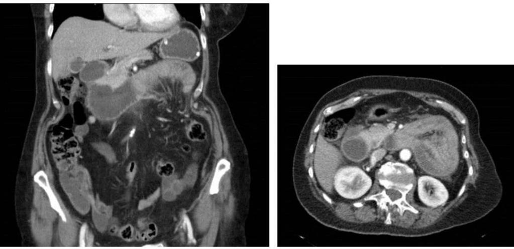 Fig. 10: Coronal reconstruction and axial CT shows a cluster of small bowel loops in the left upper quadrant.