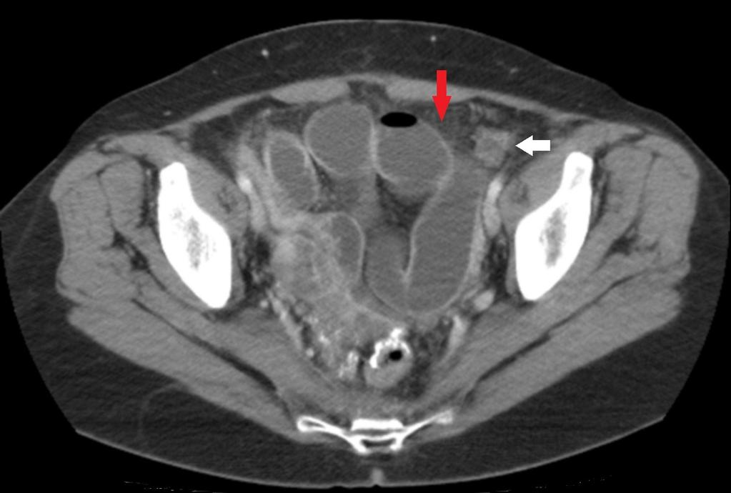 -Congestion of small mesenteric veins -Mesenteric hemorrhage -Increased attenuation of bowel wall on noncontrast scans. Images for this section: Fig.