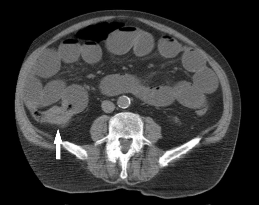 Fig. 2: Contrast-enhanced axial CT scan shows an adenocarcinoma near