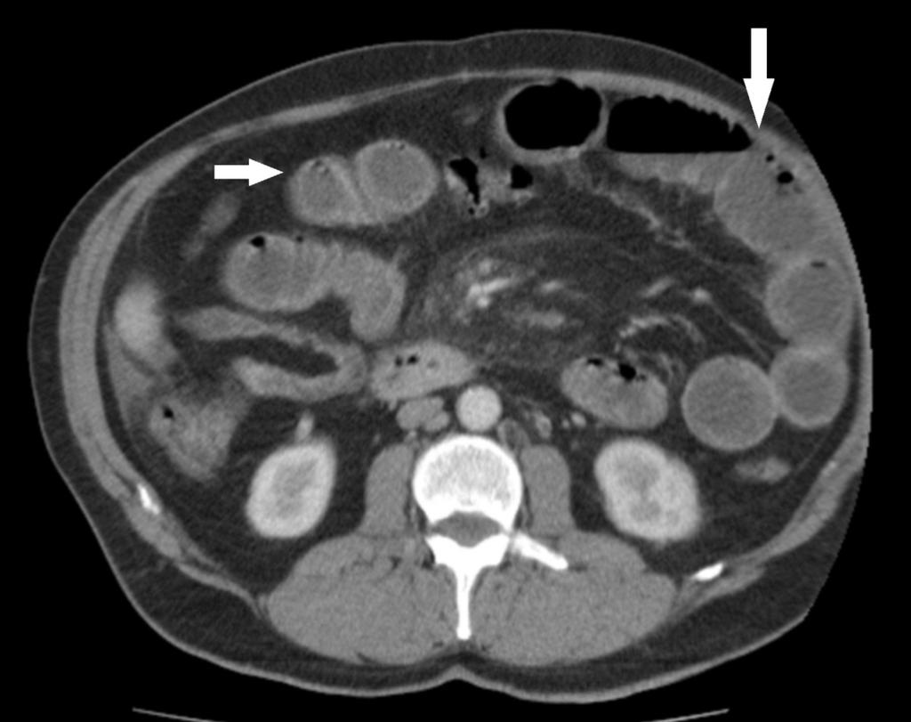 Fig. 6: A CT scan shows dilated, fluid-filled small bowel loops (white arrows) and a