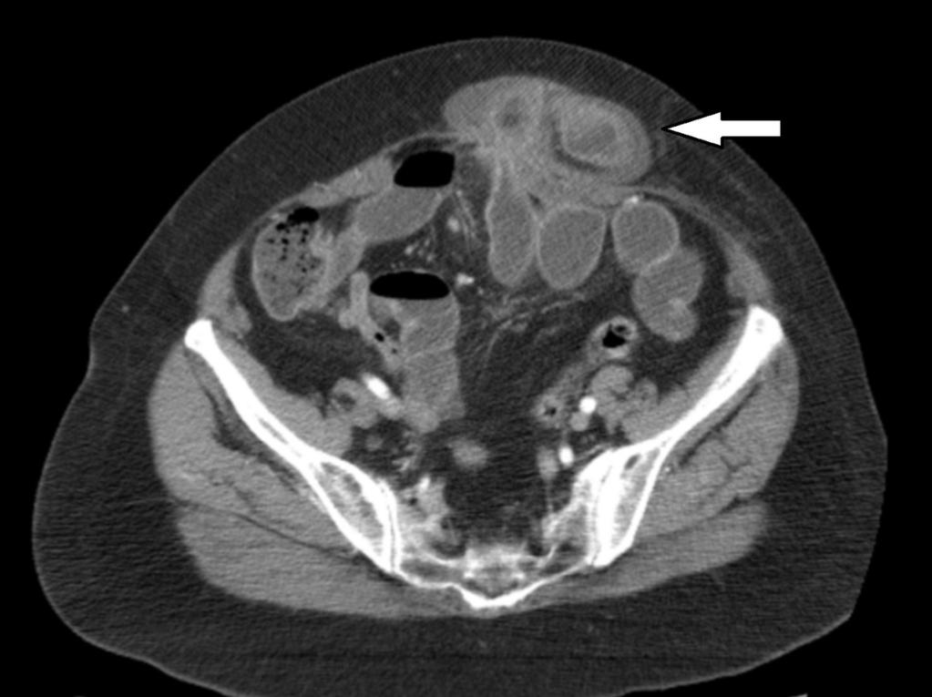 the bowel (arrows) with a small bowel