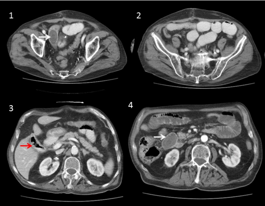 Fig. 9: Axial CT shows dilated proximal small bowel with defect in left side of abdomen (white arrow) containing bowel loop with some fluid. Distal bowel loops are not dilated. Fig.