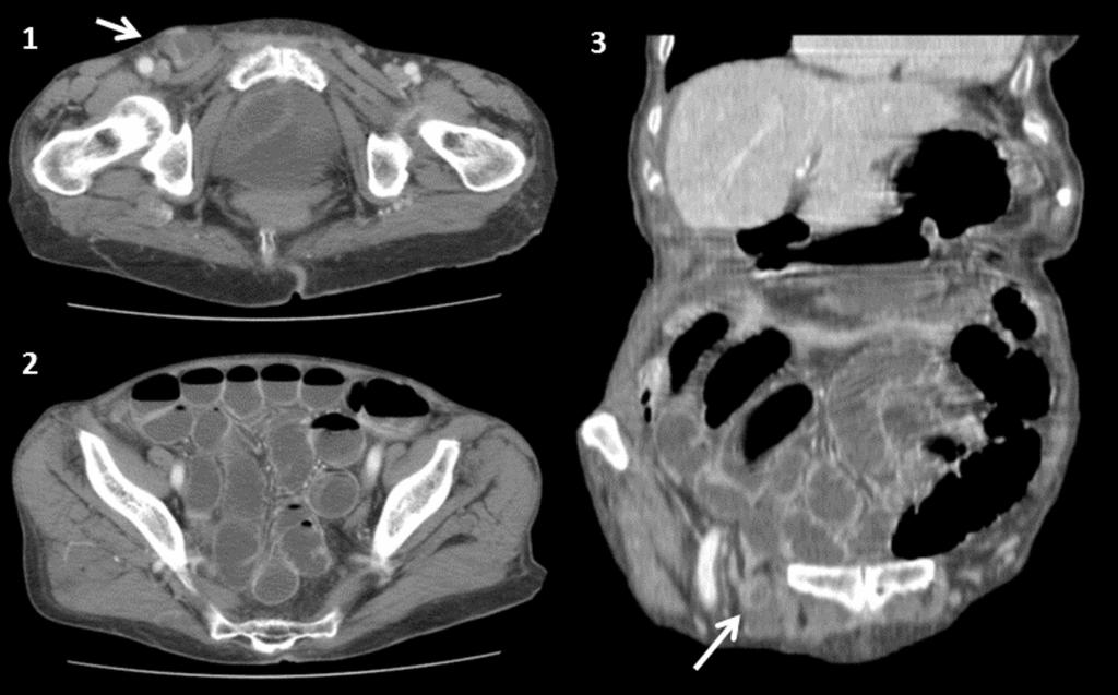 Fig. 7: Axial CT (1 and 2) and coronal reformation (3) show dilated loops of