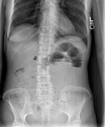 Case Presentation 67 year old otherwise healthy woman presents to the ED with a chief complaint of abdominal pain, nausea and vomiting for five days.