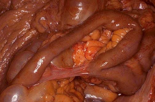 What is the cause of the patient s intestinal obstruction? Is the obstruction strangulating or non-strangulating?