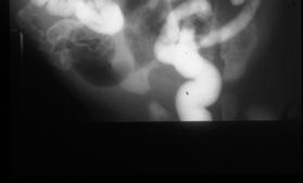 COLONIC ATRESIA Secondary to vascular insult Type I Complete obstruction by diaphragm Type II Obstruction by atretic cord Type III Complete