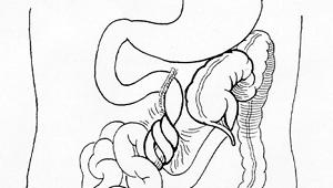 Midgut volvulus Spiraling of bowel around