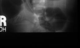 DUODENAL OBSTRUCTION Most common cause of high obstruction Atresia > stenosis > web 3/4 distal to papilla & associated with bilious vomiting 1/3 associated