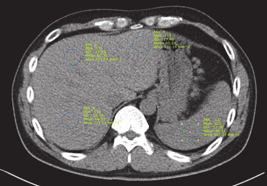 2 Gastroenterology Research and Practice (a) (b) Figure 1: Unenhanced CT images from two patients with acute pancreatitis.